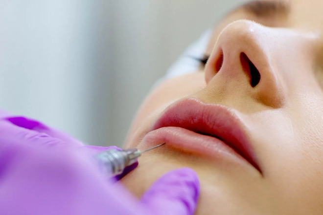 Контурная пластика губ: идеальная улыбка с помощью гиалуроновой кислоты