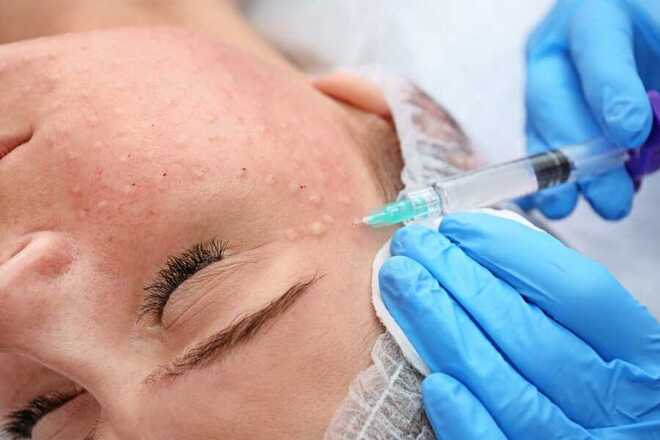 Обкалывание лица гиалуроновой кислотой: инновационная процедура для молодости и красоты